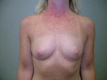 Breast Augmentation Before Photo by David Robbins, MD; West Des Moines, IA - Case 8772