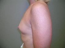 Breast Augmentation Before Photo by David Robbins, MD; West Des Moines, IA - Case 8772
