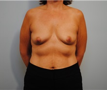 Breast Augmentation Before Photo by Roderick Zickler, MD; Harrisburg, PA - Case 38586