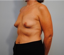Breast Augmentation Before Photo by Roderick Zickler, MD; Harrisburg, PA - Case 38586