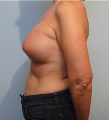 Breast Augmentation After Photo by Roderick Zickler, MD; Harrisburg, PA - Case 38586