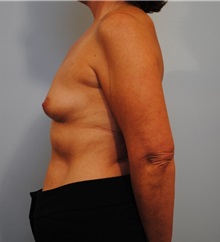 Breast Augmentation Before Photo by Roderick Zickler, MD; Harrisburg, PA - Case 38586