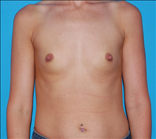 Breast Augmentation Before Photo by Winfield Hartley, MD; Boulder, CO - Case 24295