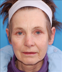 Eyelid Surgery After Photo by Winfield Hartley, MD; Boulder, CO - Case 24305