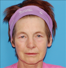 Eyelid Surgery Before Photo by Winfield Hartley, MD; Boulder, CO - Case 24305