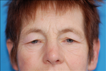 Eyelid Surgery Before Photo by Winfield Hartley, MD; Boulder, CO - Case 24305
