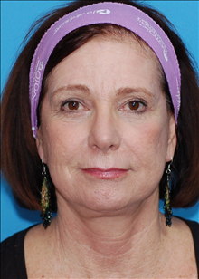 Facelift After Photo by Winfield Hartley, MD; Boulder, CO - Case 24306