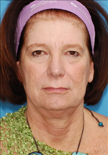 Facelift Before Photo by Winfield Hartley, MD; Boulder, CO - Case 24306