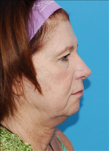 Facelift Before Photo by Winfield Hartley, MD; Boulder, CO - Case 24306