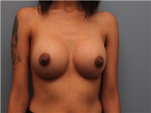 Breast Augmentation After Photo by Larry Nichter, MD; Newport Beach, CA - Case 29823 Breast Augmentation After Photo by Larry Nichter, MD; Newport Beach, CA - Case 29823