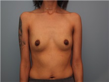 Breast Augmentation Before Photo by Larry Nichter, MD; Newport Beach, CA - Case 29823 Breast Augmentation Before Photo by Larry Nichter, MD; Newport Beach, CA - Case 29823