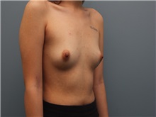 Breast Augmentation Before Photo by Larry Nichter, MD; Newport Beach, CA - Case 29825