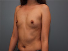 Breast Augmentation Before Photo by Larry Nichter, MD; Newport Beach, CA - Case 29827 Breast Augmentation Before Photo by Larry Nichter, MD; Newport Beach, CA - Case 29827