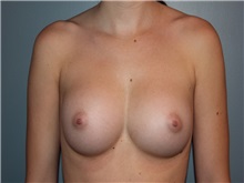 Breast Augmentation After Photo by Larry Nichter, MD; Newport Beach, CA - Case 29828 Breast Augmentation After Photo by Larry Nichter, MD; Newport Beach, CA - Case 29828