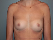 Breast Augmentation Before Photo by Larry Nichter, MD; Newport Beach, CA - Case 29828 Breast Augmentation Before Photo by Larry Nichter, MD; Newport Beach, CA - Case 29828