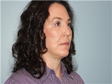 Facelift After Photo by Larry Nichter, MD; Newport Beach, CA - Case 29830