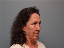 Facelift Before Photo by Larry Nichter, MD; Newport Beach, CA - Case 29830