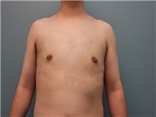 Male Breast Reduction After Photo by Larry Nichter, MD; Newport Beach, CA - Case 29831