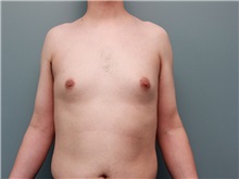Male Breast Reduction Before Photo by Larry Nichter, MD; Newport Beach, CA - Case 29831