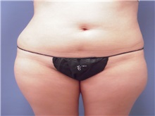Liposuction Before Photo by Larry Nichter, MD; Newport Beach, CA - Case 29835
