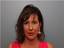 Facelift After Photo by Larry Nichter, MD; Newport Beach, CA - Case 29837