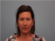Facelift Before Photo by Larry Nichter, MD; Newport Beach, CA - Case 29837