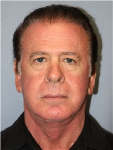 Facelift After Photo by Larry Nichter, MD; Newport Beach, CA - Case 29839