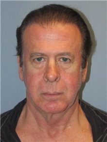 Facelift Before Photo by Larry Nichter, MD; Newport Beach, CA - Case 29839