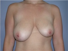 Breast Lift Before Photo by Larry Nichter, MD; Newport Beach, CA - Case 29843