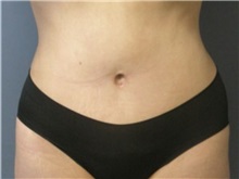 Tummy Tuck After Photo by Larry Nichter, MD; Newport Beach, CA - Case 29845 Tummy Tuck After Photo by Larry Nichter, MD; Newport Beach, CA - Case 29845