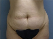 Tummy Tuck Before Photo by Larry Nichter, MD; Newport Beach, CA - Case 29845 Tummy Tuck Before Photo by Larry Nichter, MD; Newport Beach, CA - Case 29845