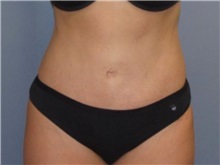 Tummy Tuck After Photo by Larry Nichter, MD; Newport Beach, CA - Case 29846