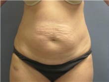 Tummy Tuck Before Photo by Larry Nichter, MD; Newport Beach, CA - Case 29846