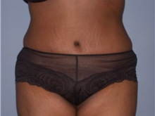 Tummy Tuck After Photo by Larry Nichter, MD; Newport Beach, CA - Case 29848