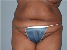 Tummy Tuck Before Photo by Larry Nichter, MD; Newport Beach, CA - Case 29848