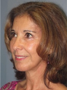 Chin Augmentation After Photo by Larry Nichter, MD; Newport Beach, CA - Case 29851