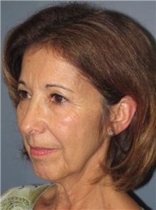 Chin Augmentation Before Photo by Larry Nichter, MD; Newport Beach, CA - Case 29851