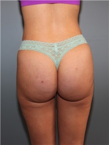 Buttock Lift with Augmentation After Photo by Larry Nichter, MD; Newport Beach, CA - Case 29856