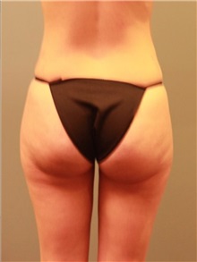 Buttock Lift with Augmentation Before Photo by Larry Nichter, MD; Newport Beach, CA - Case 29856