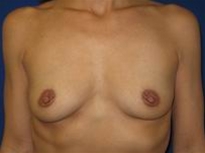Breast Augmentation Before Photo by Joe Gryskiewicz, MD, FACS; Burnsville, MN - Case 22581
