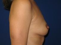 Breast Augmentation Before Photo by Joe Gryskiewicz, MD, FACS; Burnsville, MN - Case 22581