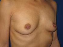 Breast Augmentation Before Photo by Joe Gryskiewicz, MD, FACS; Burnsville, MN - Case 22581