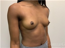 Breast Augmentation Before Photo by Camille Cash, MD; Houston, TX - Case 47277
