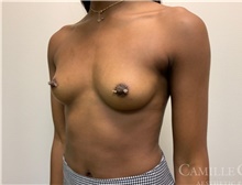 Breast Augmentation Before Photo by Camille Cash, MD; Houston, TX - Case 47277