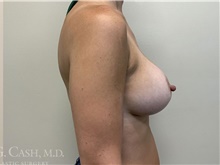 Breast Augmentation After Photo by Camille Cash, MD; Houston, TX - Case 47278