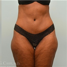 Tummy Tuck After Photo by Camille Cash, MD; Houston, TX - Case 47279