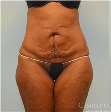 Tummy Tuck Before Photo by Camille Cash, MD; Houston, TX - Case 47279