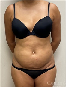 Tummy Tuck Before Photo by Camille Cash, MD; Houston, TX - Case 47280