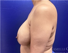 Breast Implant Removal Before Photo by Camille Cash, MD; Houston, TX - Case 47283