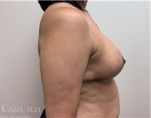Breast Implant Removal After Photo by Camille Cash, MD; Houston, TX - Case 47283